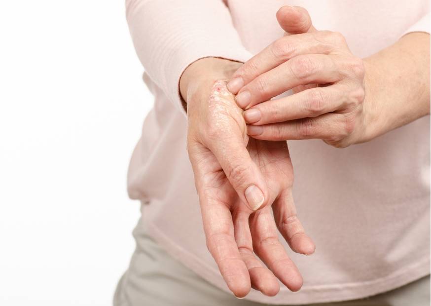 Psoriasi | Acqua Sorgesana