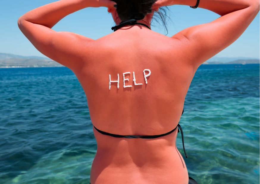 Scottature solari, come prevenirle e curarle | Acqua naturale Sorgesana