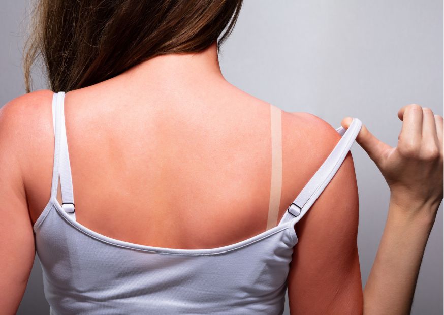 Prepara la pelle al sole e previeni le scottature | Acqua Sorgesana